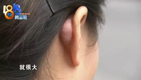 隆鼻后,耳朵后长了个大包,还在变大?