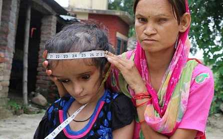 一少女跌了一跤导致脑袋长成西瓜一样大