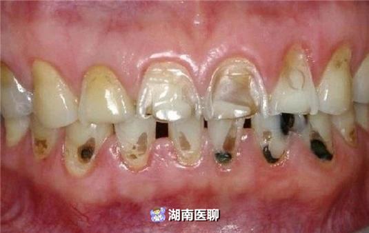 大学生可乐当水喝,牙齿敏感疼痛难忍!得了"酸蚀症"?