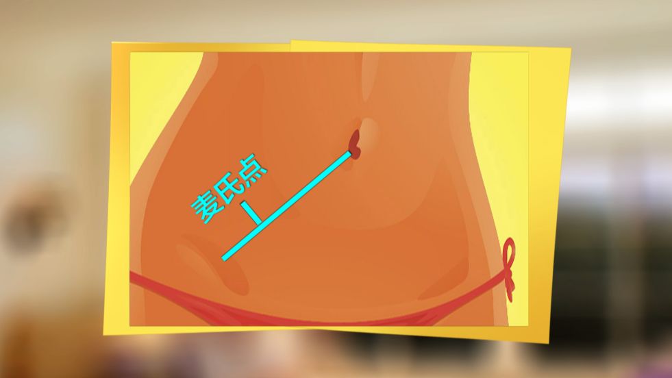 其实,检测阑尾炎最根本的就是要刺激到阑尾所在的地方,也就是麦氏点