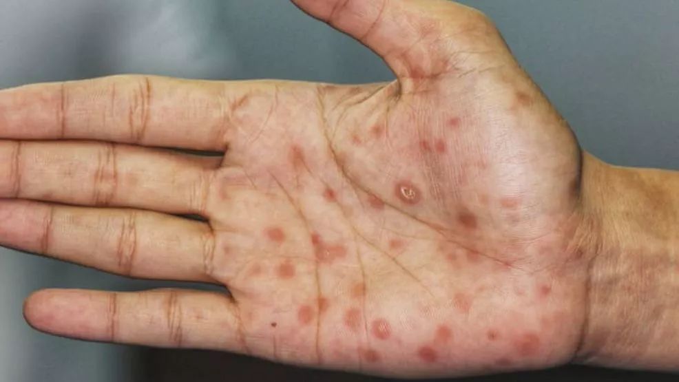 病科合并到一起,正是因为大多数性病的临床表现常常以皮肤症状为主