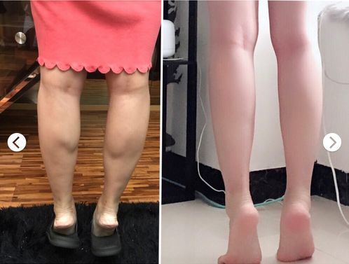 小红书 慧慧哥_ 和吸脂不同,瘦腿针只能打小腿,所以更适合小腿粗子行