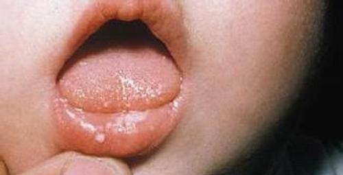 婴儿上颚口腔溃疡图片图片