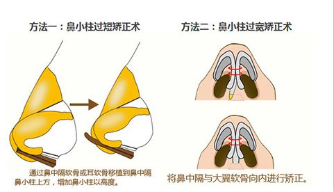 好看的鼻子重点不只是鼻头和鼻梁 还有鼻小柱