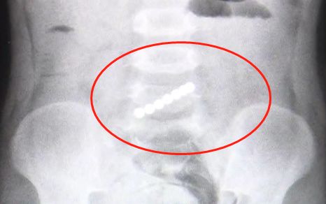 一岁男童肚子内惊现致命七龙珠,这种玩具不要