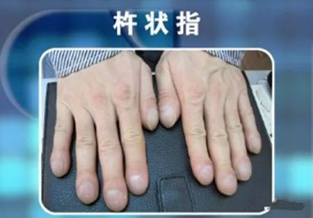 肺癌|杵状指|手指_新浪新闻