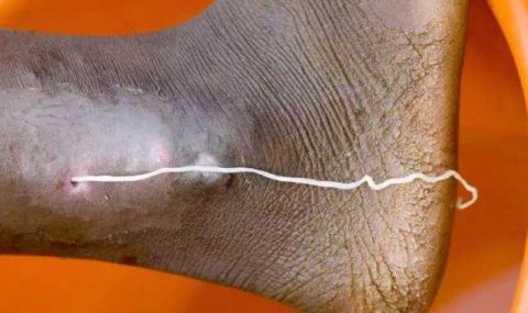 天花之后又一种肆虐上千年的流行病要被人类灭绝了