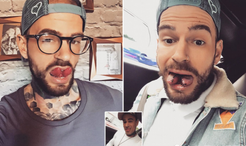 男子通过手术让舌头分岔,完成儿时梦想:拥有像蛇一样分岔的舌头