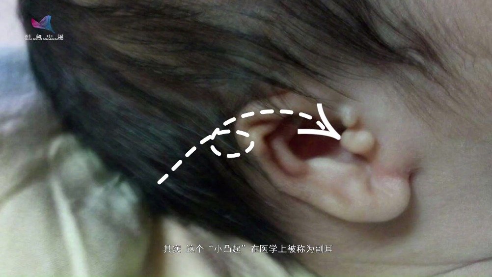 耳朵上的"小凸起"能切除吗?