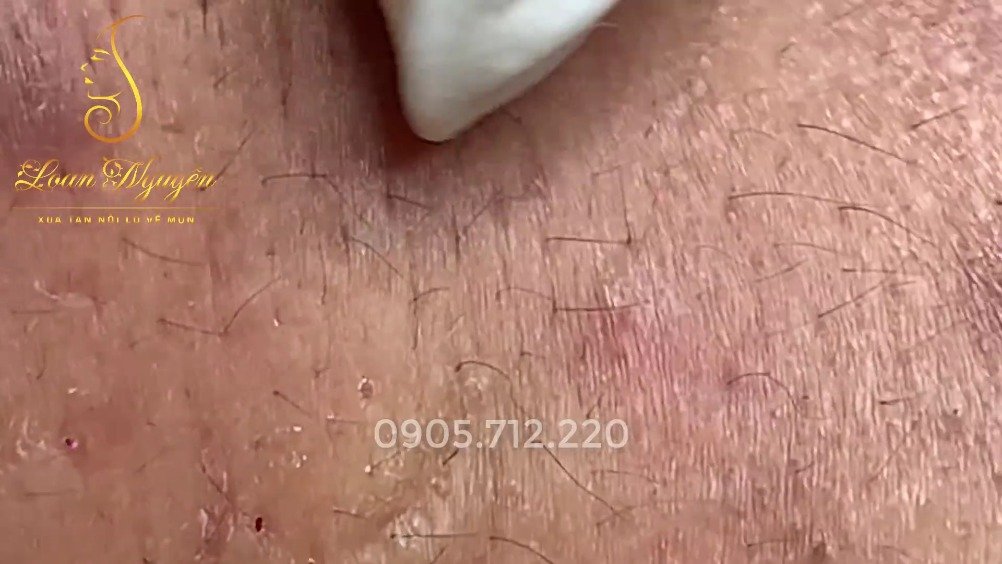 针挑黑头第5022部