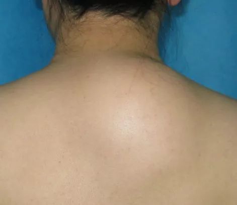 背部最容易长恶性肿瘤图片