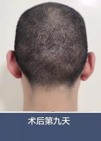 去哪里学习植发好?