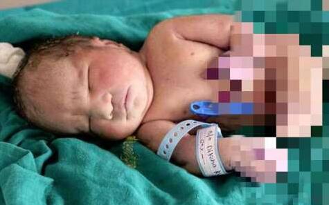 印度母亲产下"美人鱼宝宝"双腿融合 出生后15分钟离世