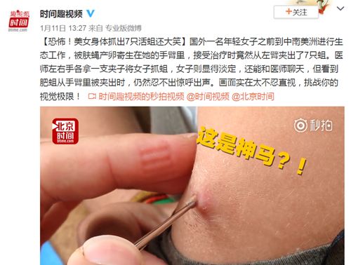 女子皮肤里取出"白色小虫"竟是因为吃了小龙虾?两者无关