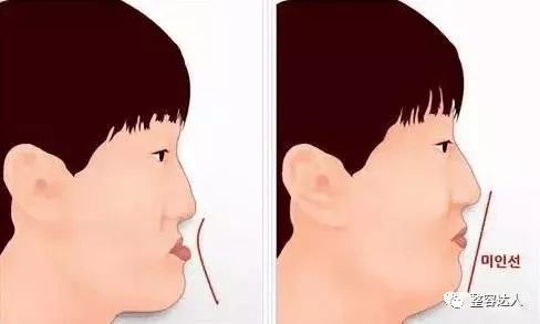 亚洲人和欧美人相比普遍面部扁平没有立体感,而主要作用的就是鼻子