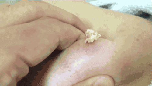 挤痘痘你真的会吗|痘痘|白色|粉刺_新浪女性_新浪网