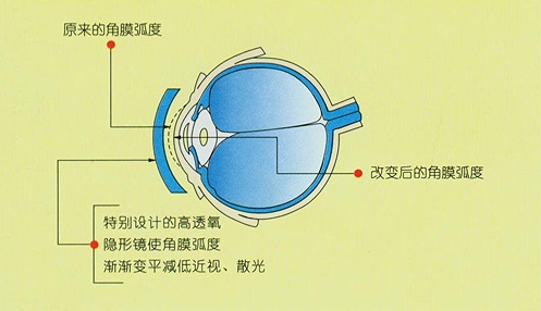 夜晚戴镜,白天摘镜3—7天快速恢复1.