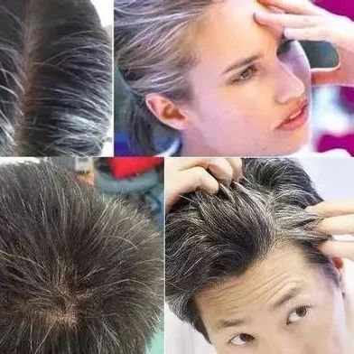 我才岁就有白头发 到底哪里出了问题 我才岁就有白头发 到底哪里出了问题