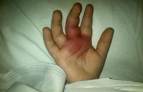 男子发现墙面有蜘蛛 徒手拍死没多久一看手掌"悲剧"了