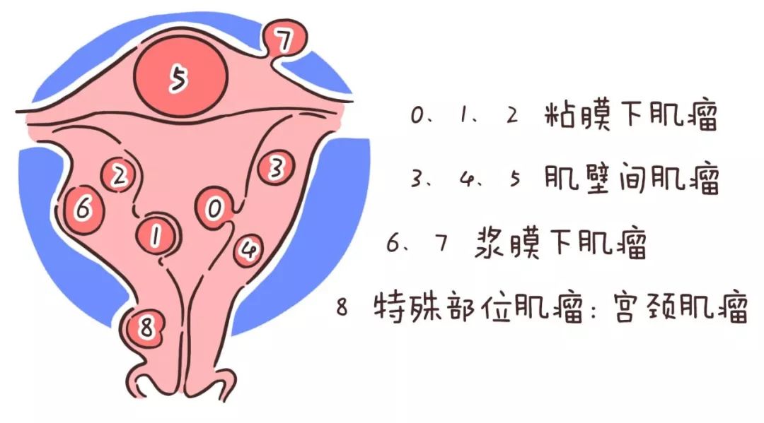 假设我们的子宫是孕育生命的房子,如果是向外生长的浆膜下肌瘤,那就