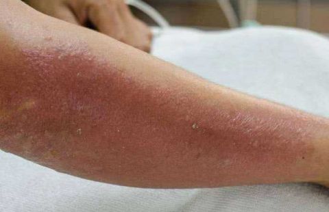 可能是由于怀孕之后体内激素紊乱,让她患有了一种水性荨麻疹,简单来说