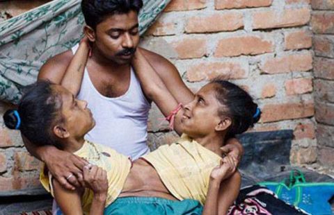 直击印度连体姐妹的生活拥有共同的男友都想为他生孩子