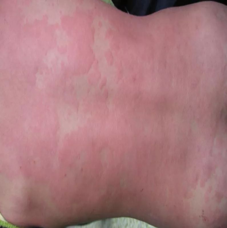 宝宝浑身起 风疙瘩 原因竟然不是过敏 手机新浪网