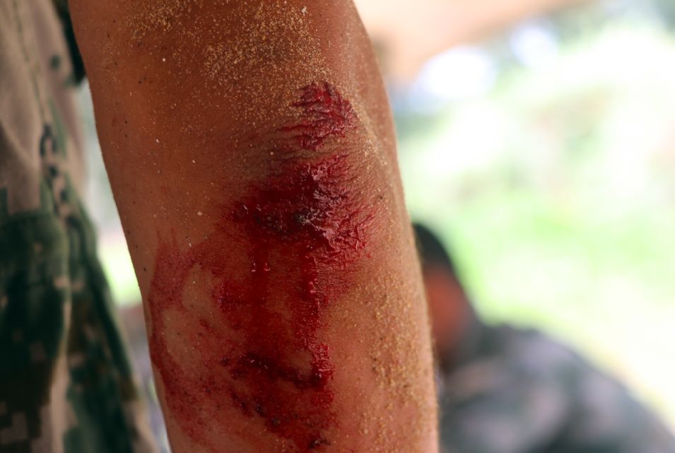 上等兵刘洪江,训练后右臂严重挫伤,他今年决定转士官海训光影纪录