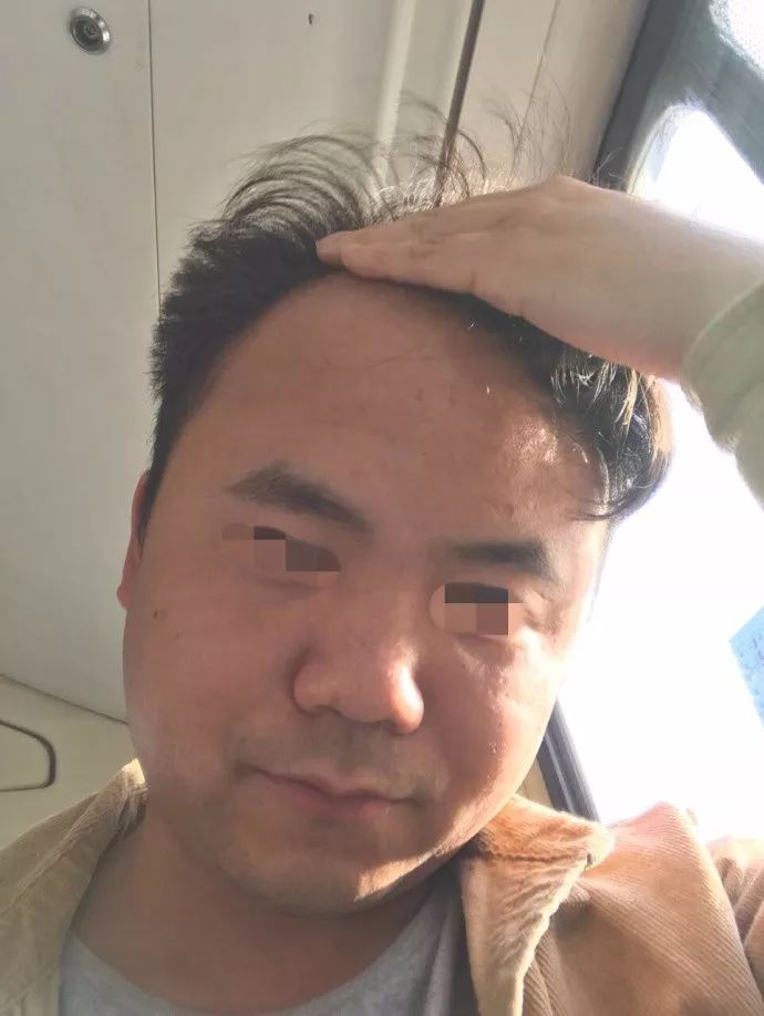 网友晒出四年前后对比照奉劝大家千万不要再熬夜了