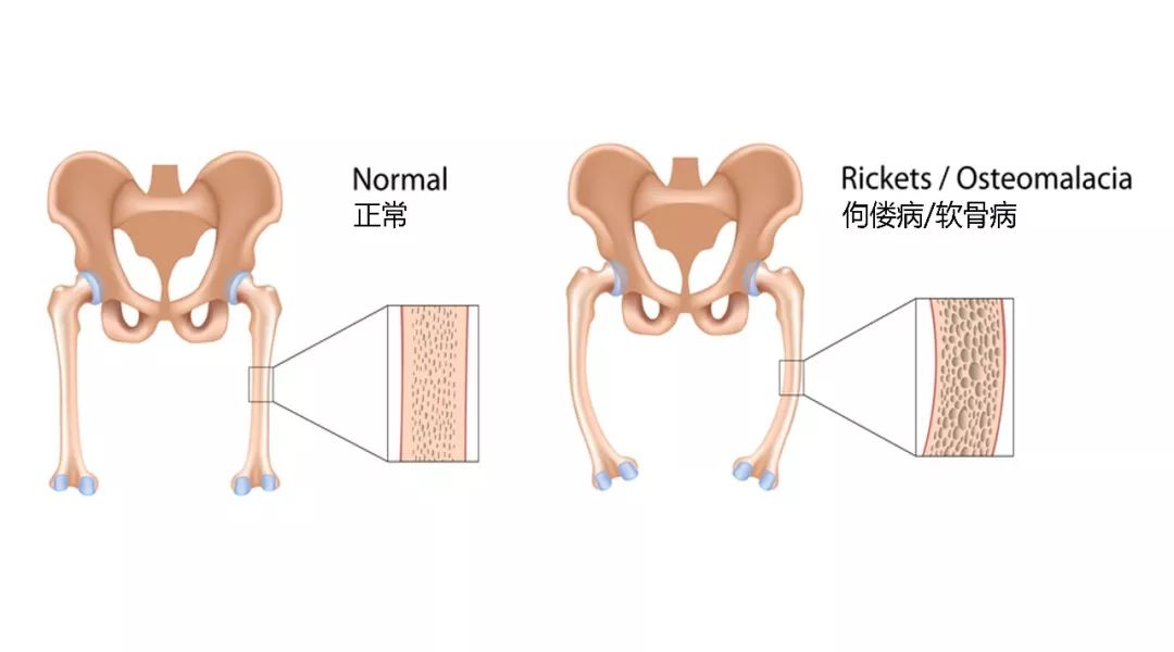罕见病目录低磷性佝偻病