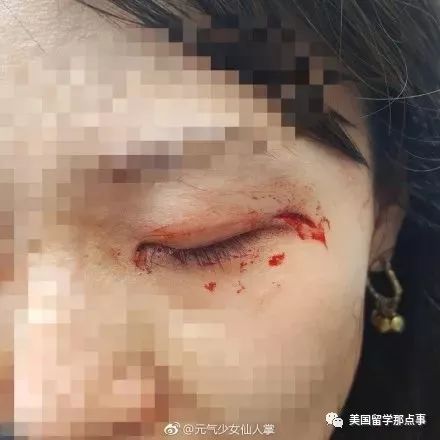 中国女生在纽约被三名黑人女子暴打满脸是血警察却敷衍了事