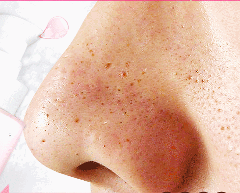 痘痘痘印烂脸怎么办这个8000人疯传的绝招我替你们试过了