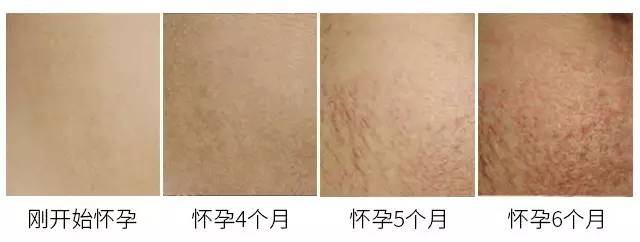 终于找到baby"代孕"的证据了|妊娠纹|激光|疤痕_新浪女性_新浪网