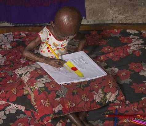 孟加拉女孩得罕见衰老症,预期寿命只剩3年,依旧乐观生活