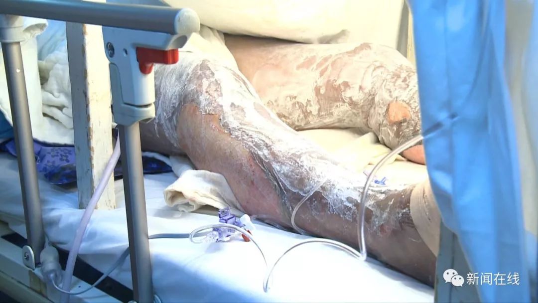 新婚仅三天,父亲就遭遇爆炸全身烧伤!