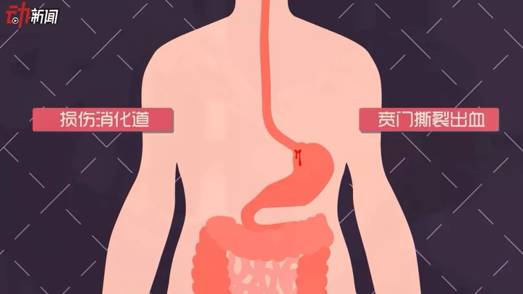 胃贲门的位置图片图片