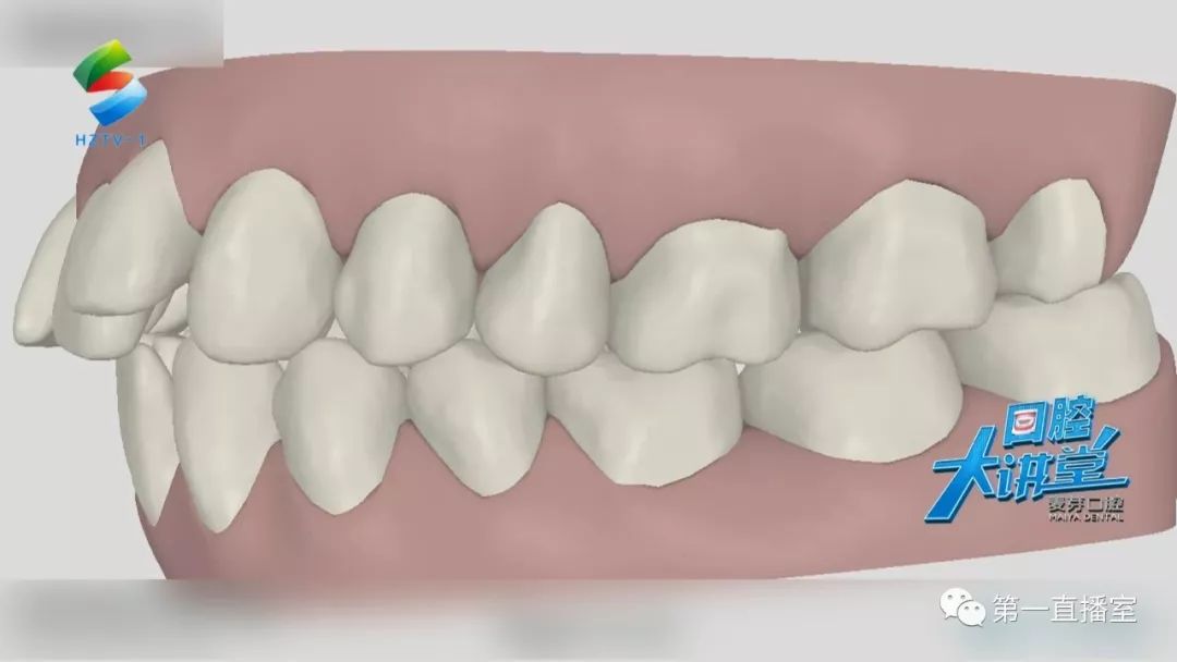 口腔大讲堂只有一排牙齿不齐为什么不能只矫正半口