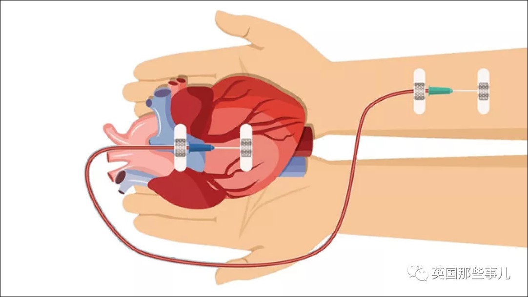 他们移植了同一人的器官,却全患上癌症…这也太防不胜防了吧|癌症|癌