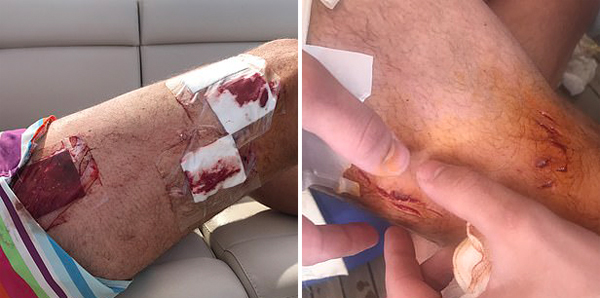 奥地利男子红海潜水被鲨鱼咬腿死里逃生