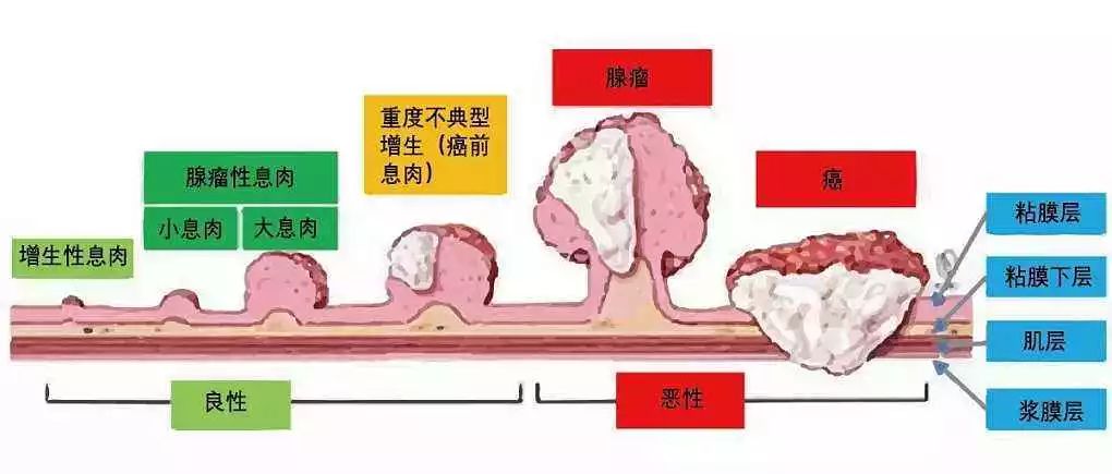 直肠癌|结肠镜|便秘_新浪新闻