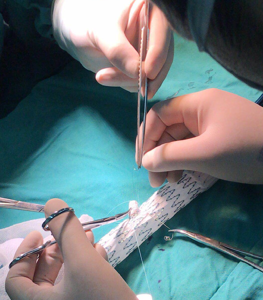 鼓医血管外科完成国内首例三分支支架治疗胸腹主动脉瘤