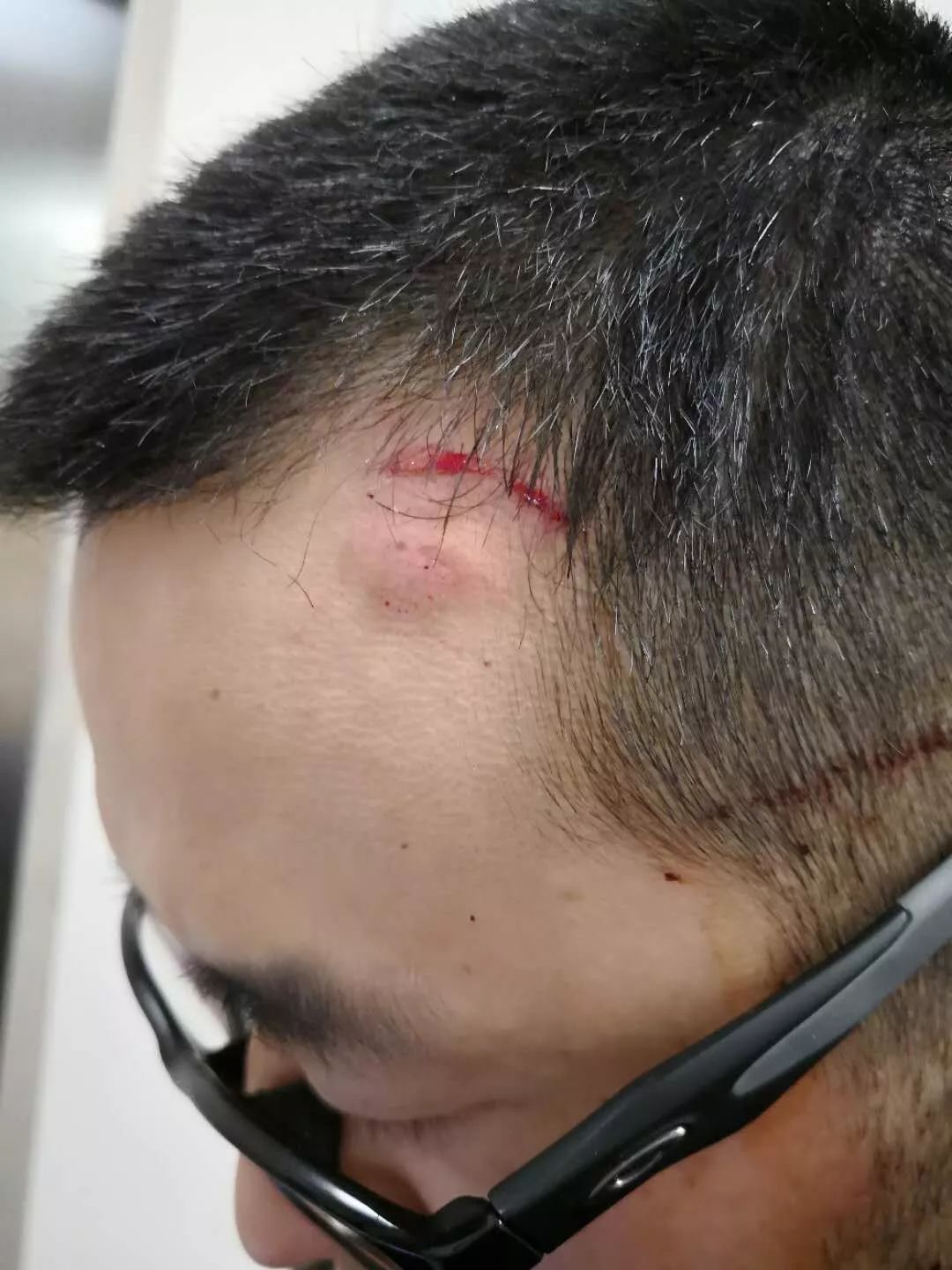 因为他个子小,手脚够不到我,就拿起手中钝器甩了十几下,一直朝着我