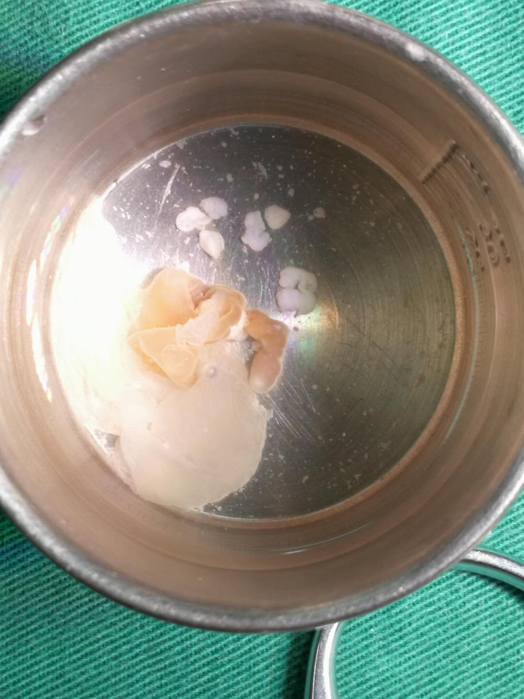 囊虫寄居男子大脑二十余年,鼓医神外专家上演"脑内捉虫计"