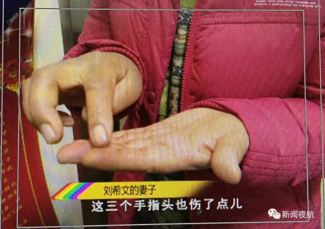 肇源一男子放鞭炮炸伤手,处置不当感染破伤风!小伤口也不大意不得!|破