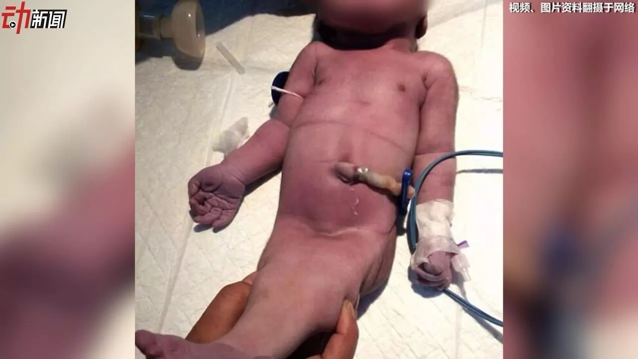 女子产"美人鱼宝宝" 这些习惯是诱因