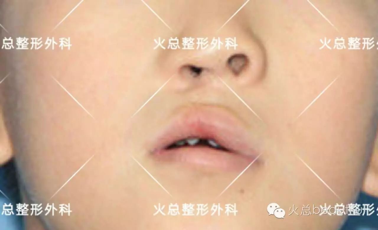 广州有哪些做唇腭裂修复医院? - 知乎