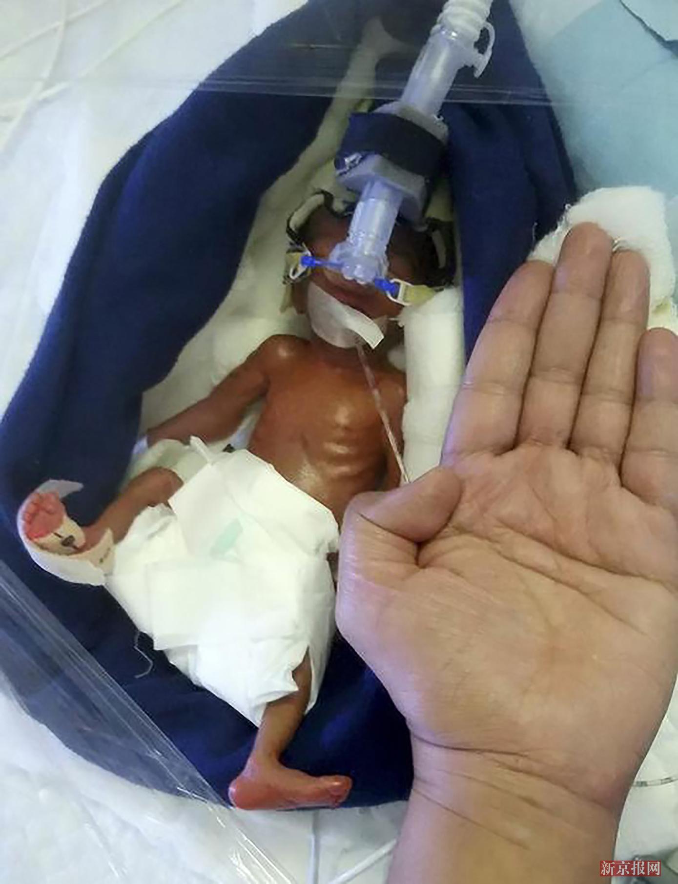 印度女子产下"巴掌女婴"仅重0.8斤 动画揭是啥原因