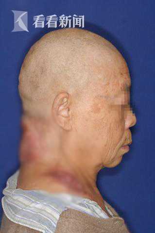 老太颈项肿瘤溃烂求治无门 九院医者妙手解除病