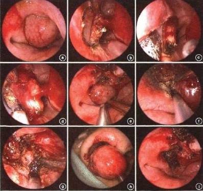 网传老鼻炎易发展成为鼻咽癌这是真的吗