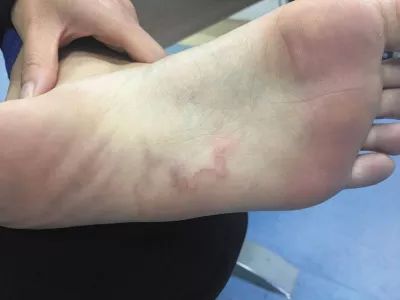 回国后没几天,年轻妻子发现脚底又痛又痒,脚底皮肤出现了弯曲的红线